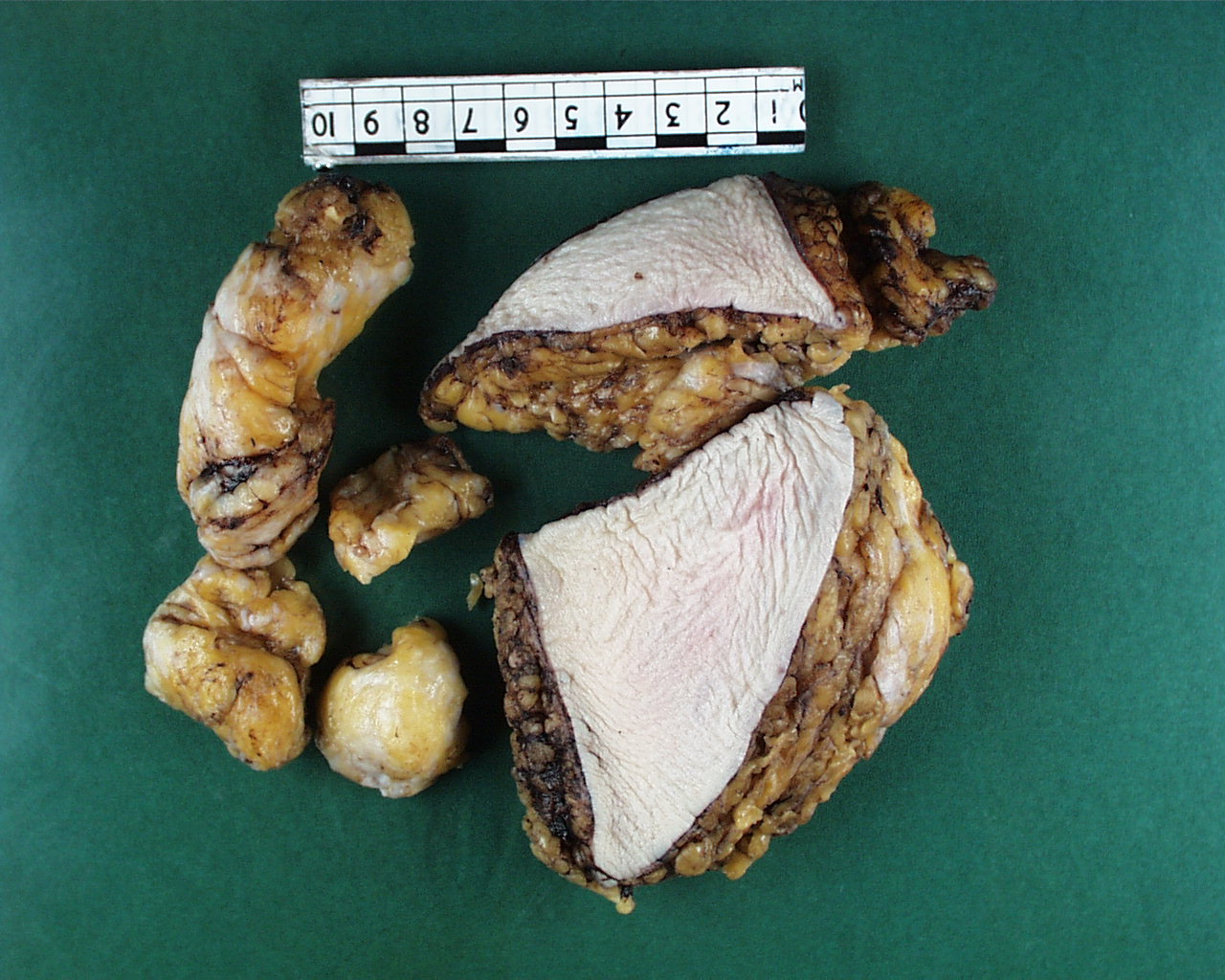 A breast reduction specimen