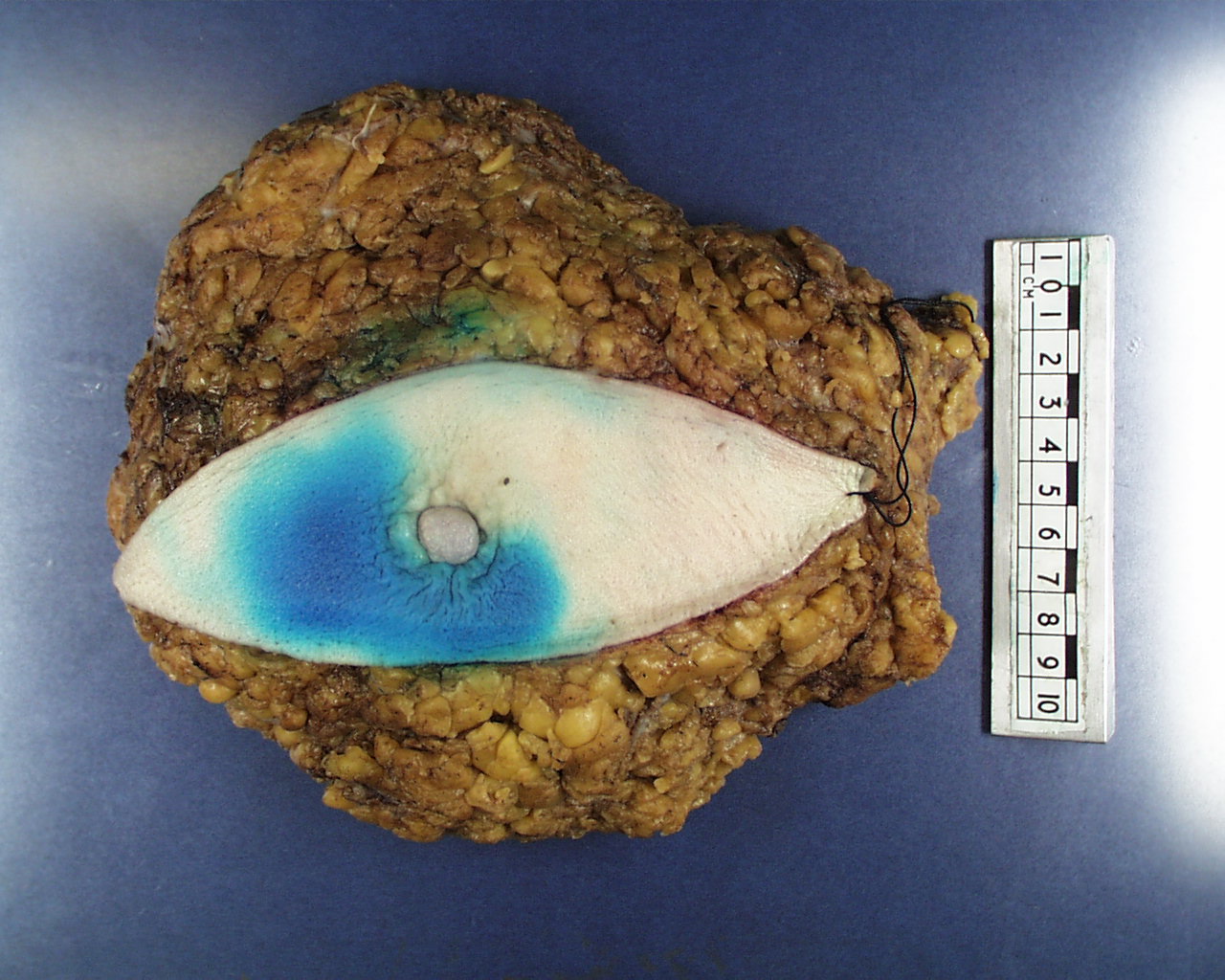 A mastectomy without attached axillary tail