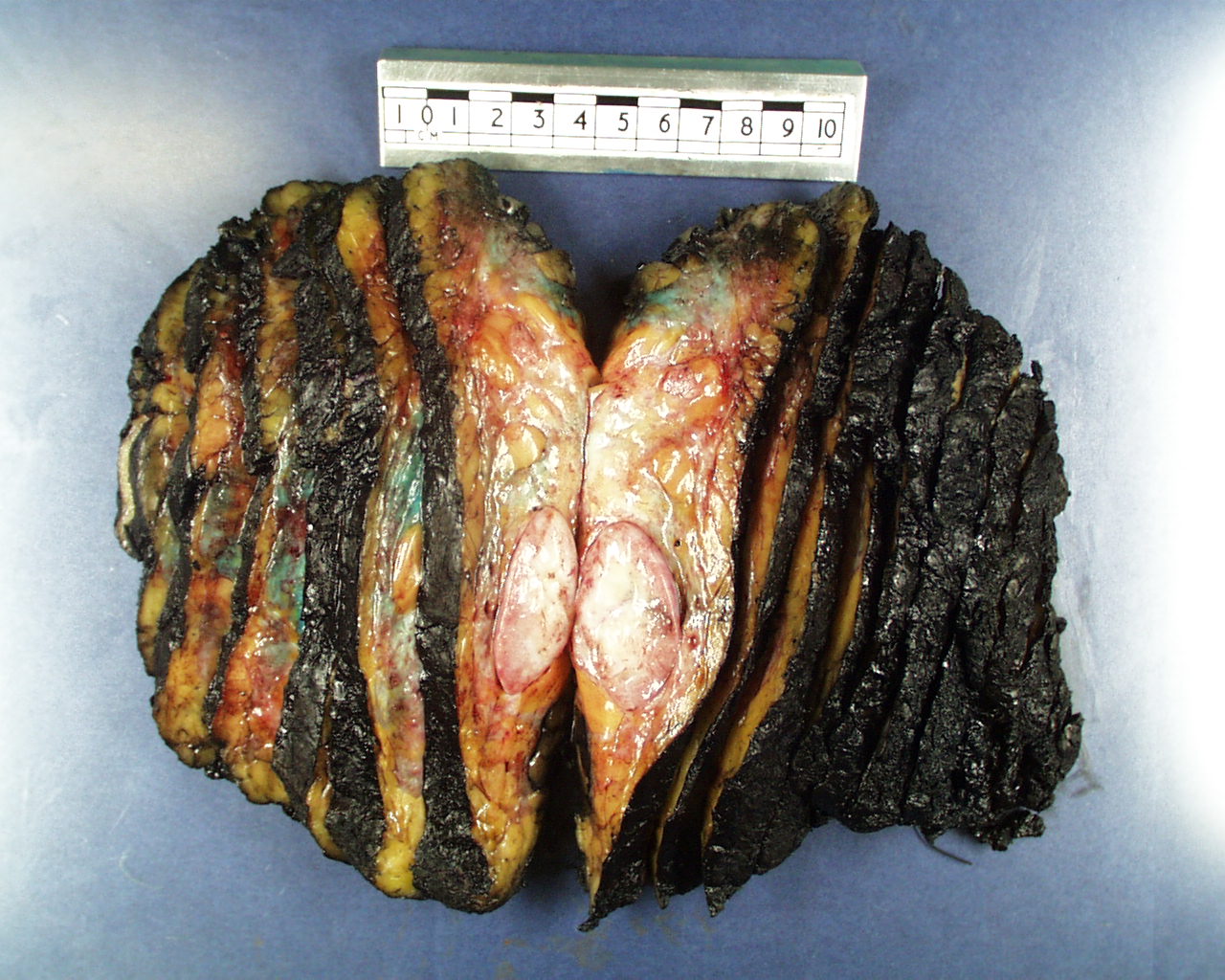 Sliced mastectomy