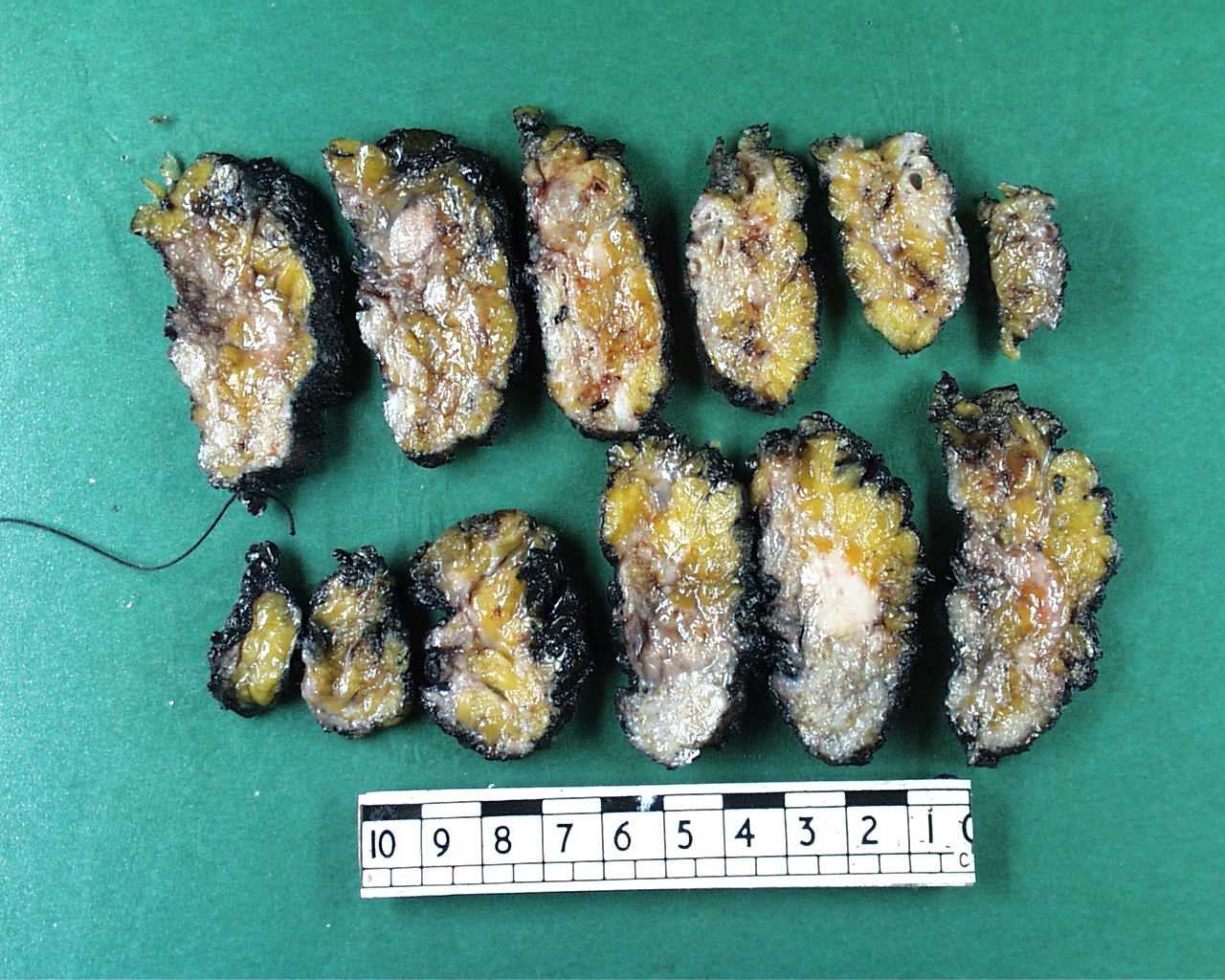 A sliced wide local excision of the breast