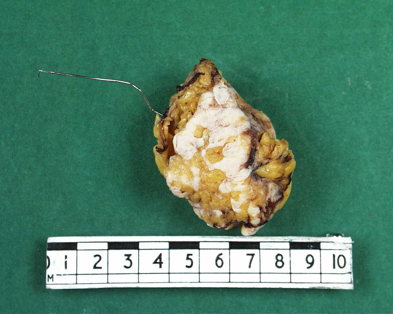 A wire-guided breast excision