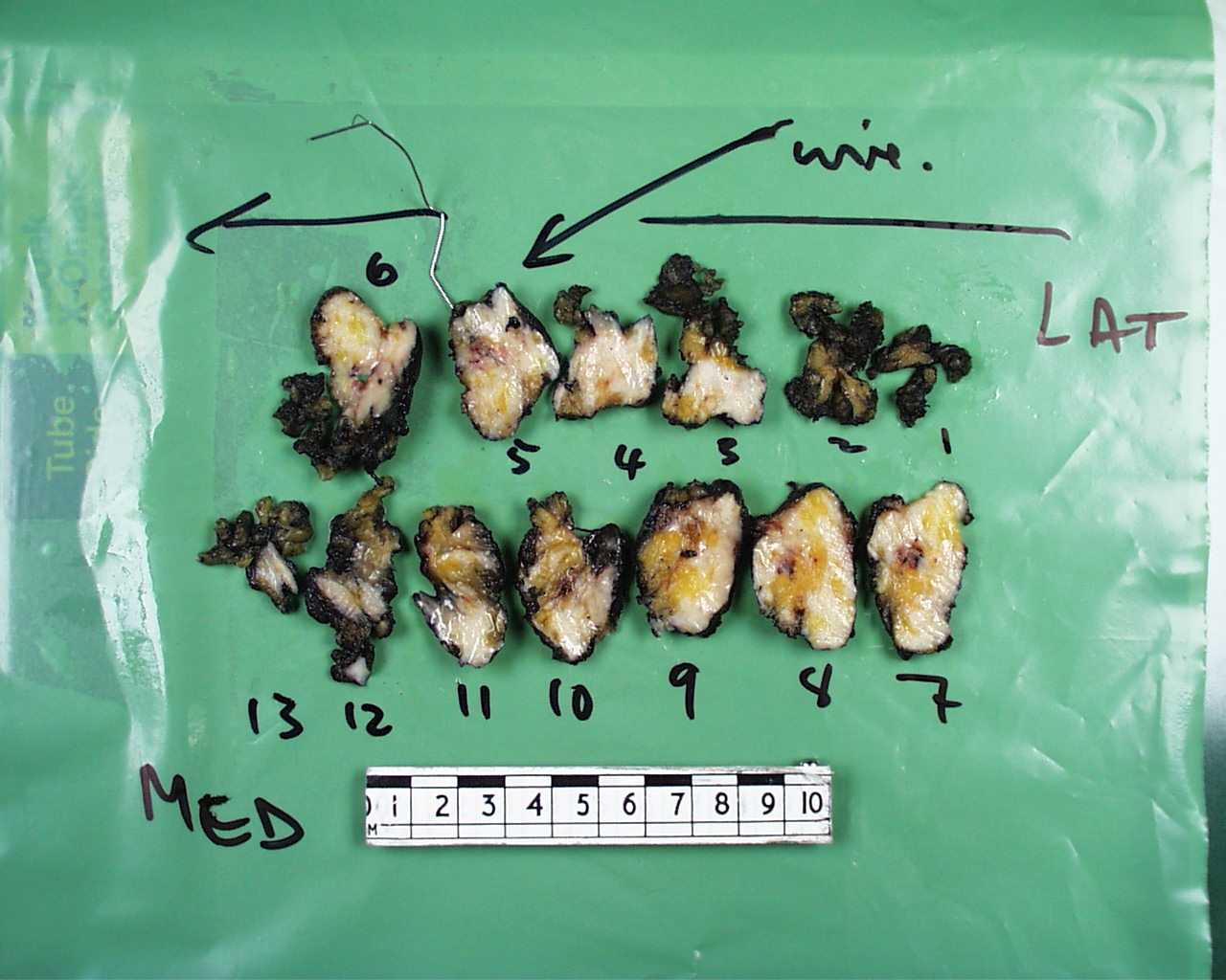 A sliced wire-guided breast excision
