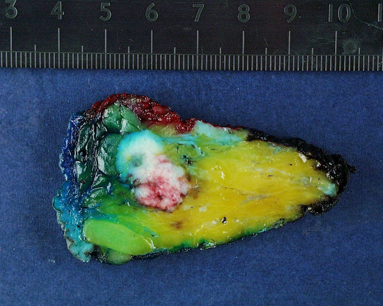 Breast