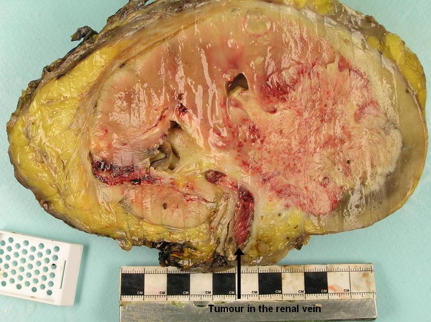 Kidney