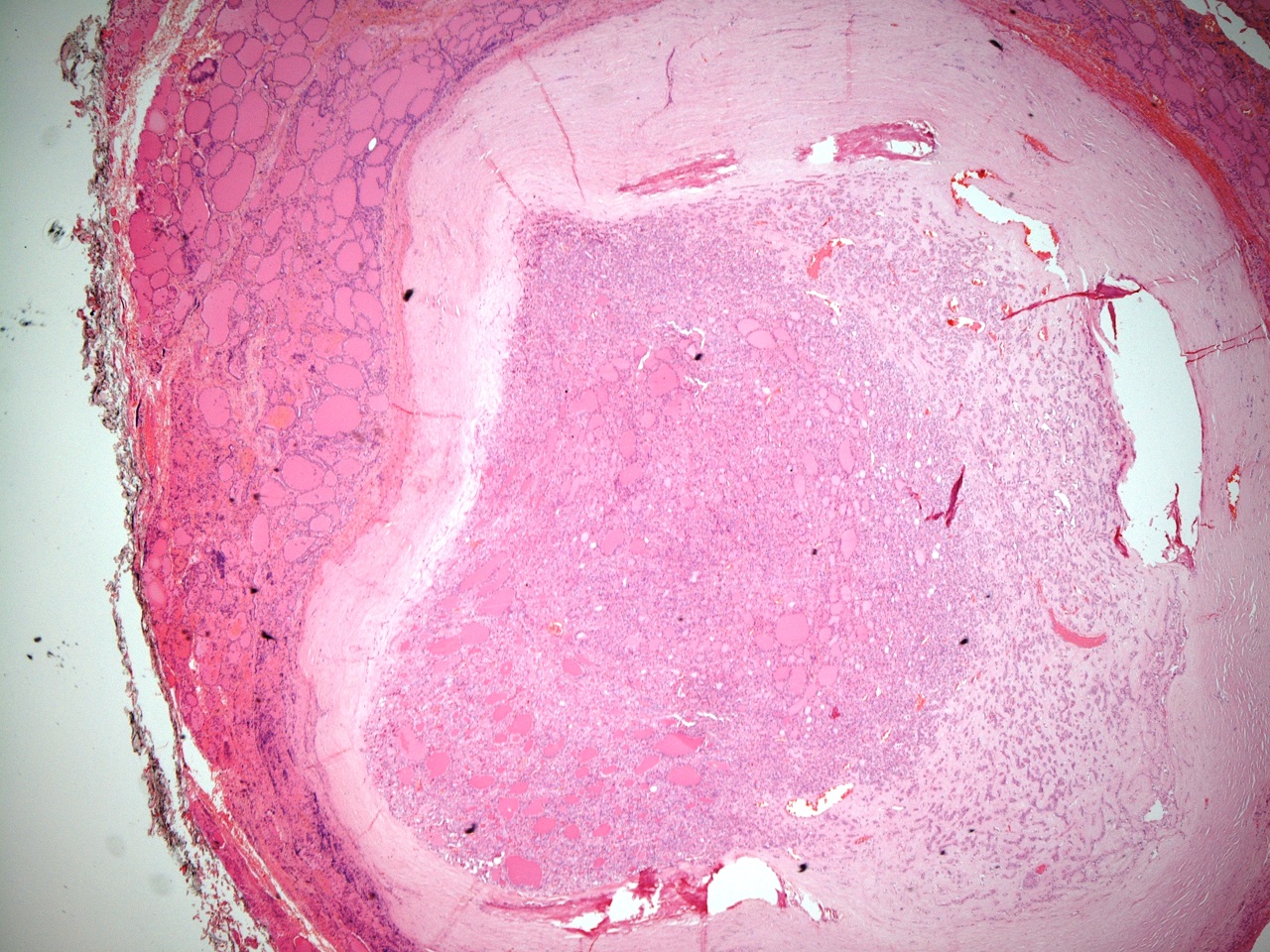 Follicular adenoma