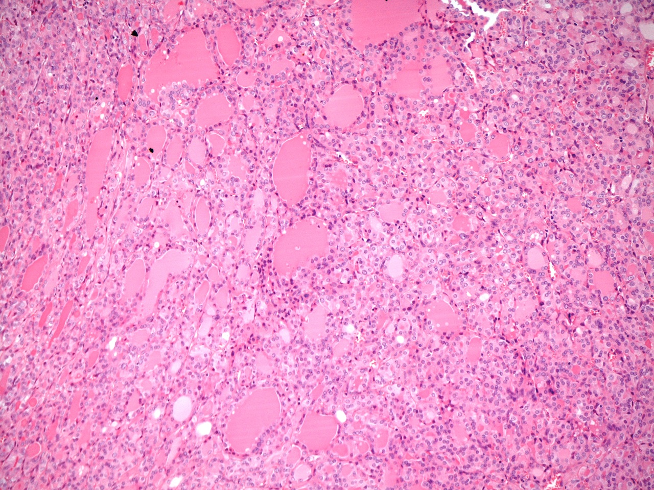 Follicular adenoma
