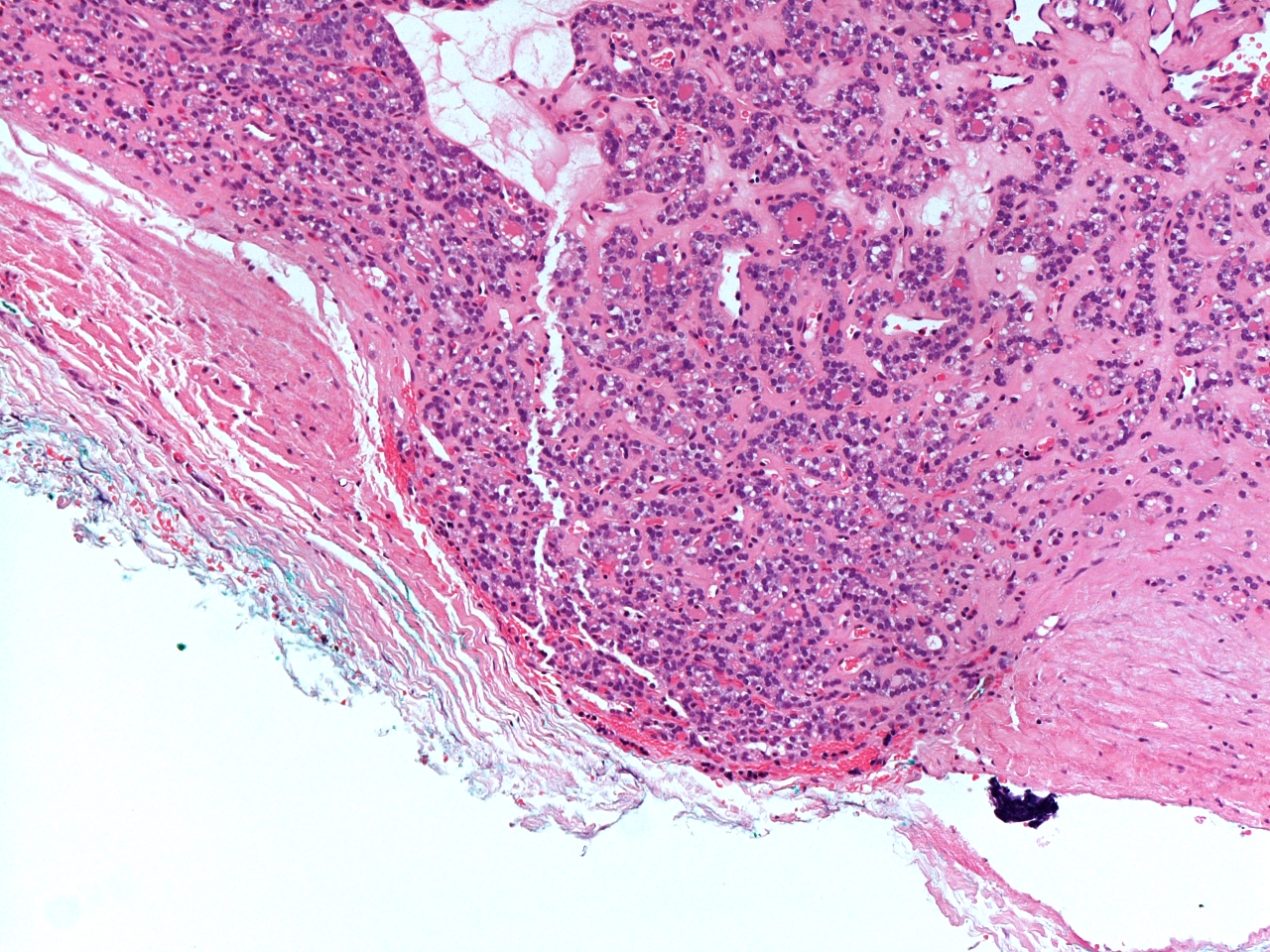 Follicular carcinoma