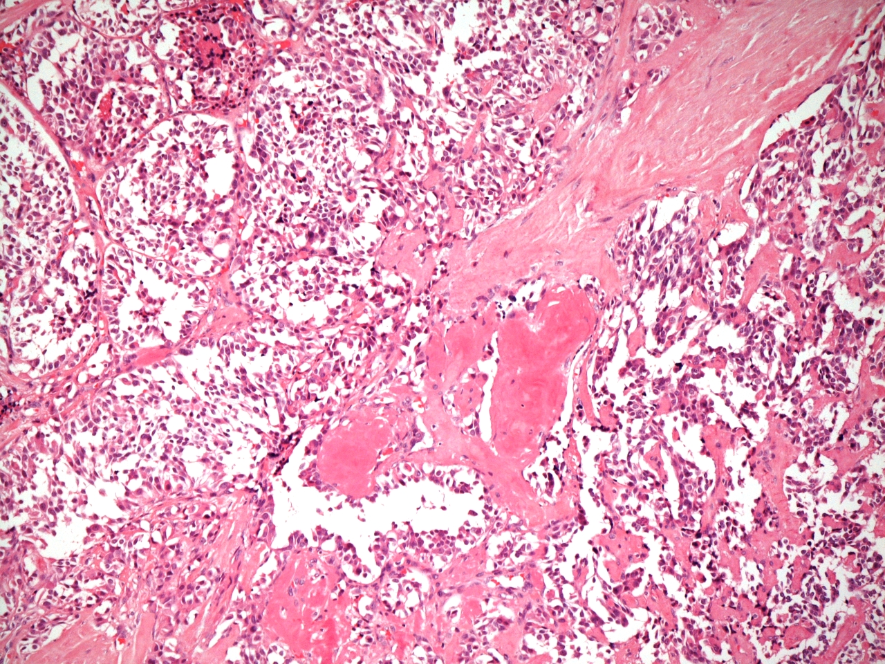 Medullary carcinoma