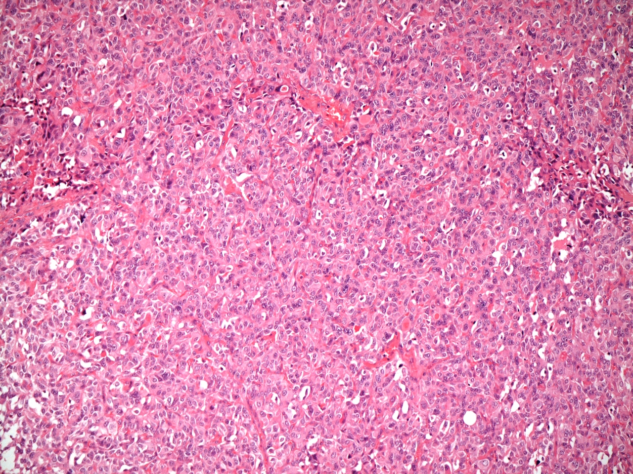 Medullary carcinoma