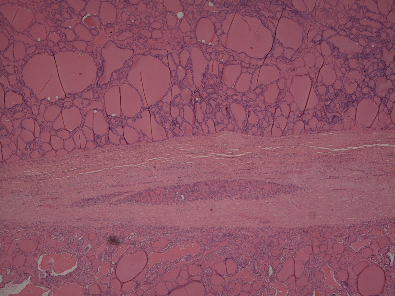 Histology of a multinodular goitre