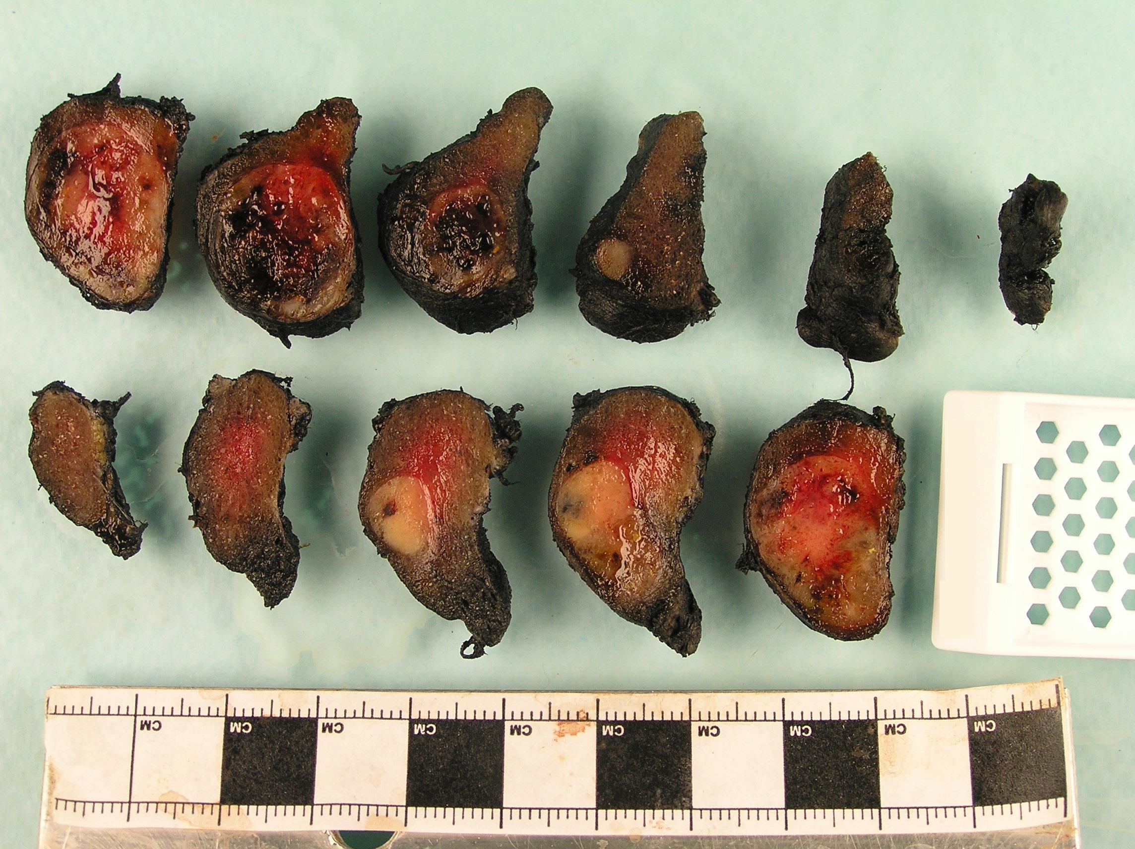 Papillary carcinoma