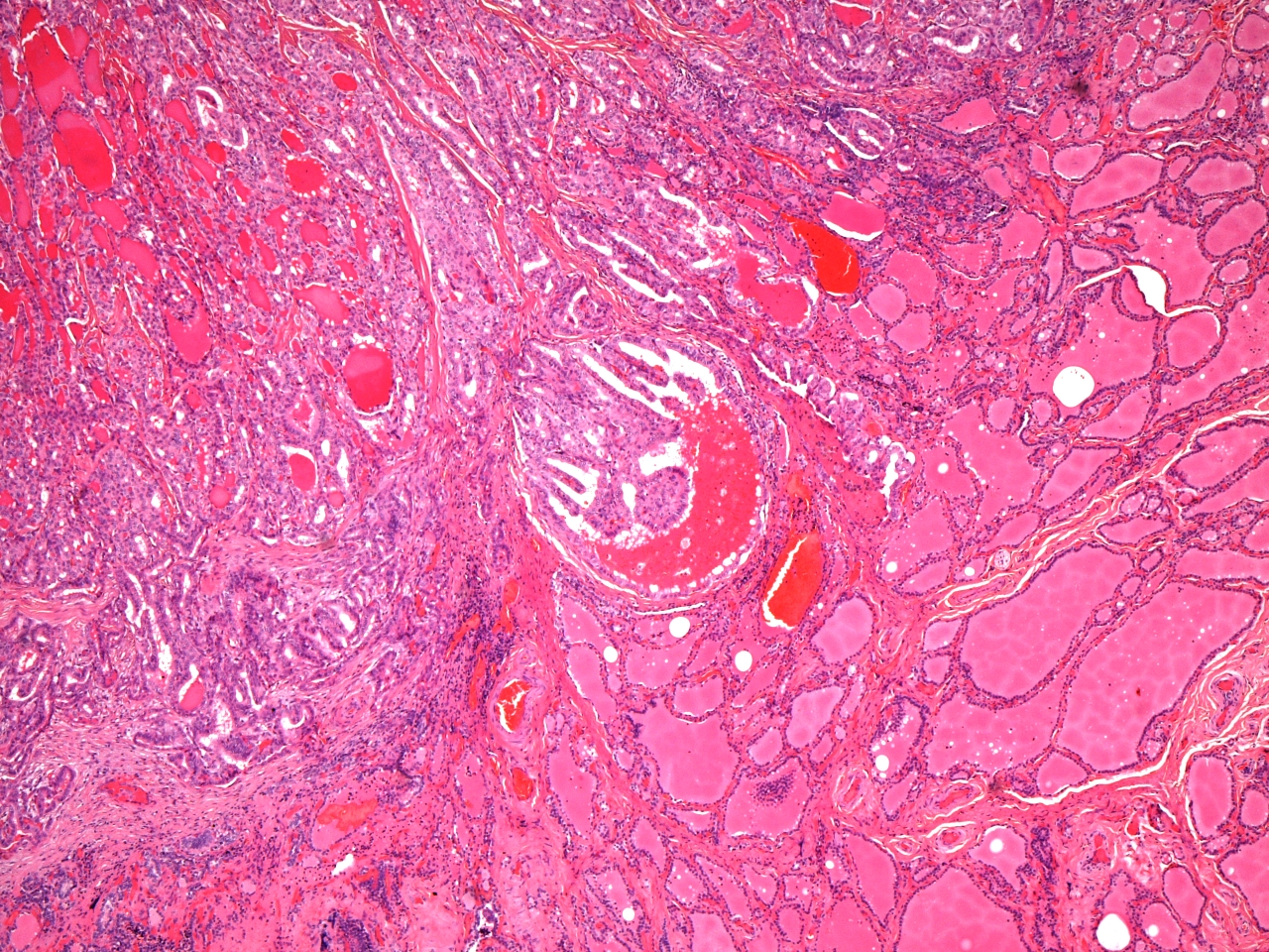 Papillary carcinoma
