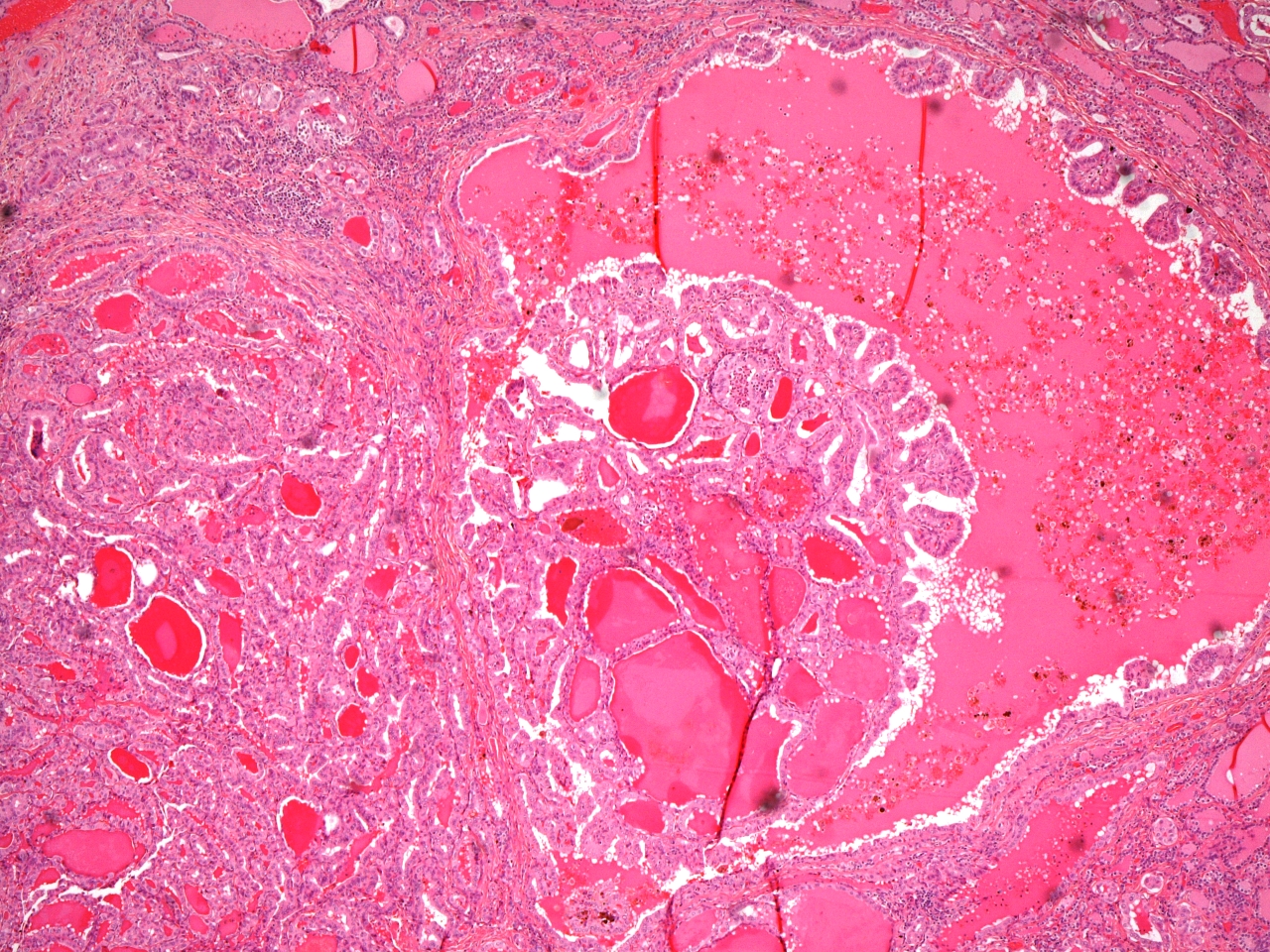 Papillary carcinoma