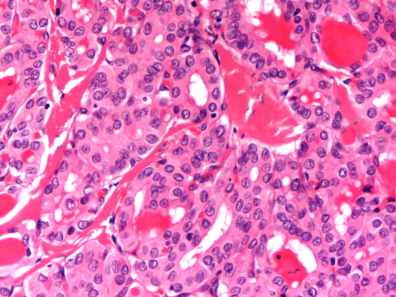 Papillary carcinoma