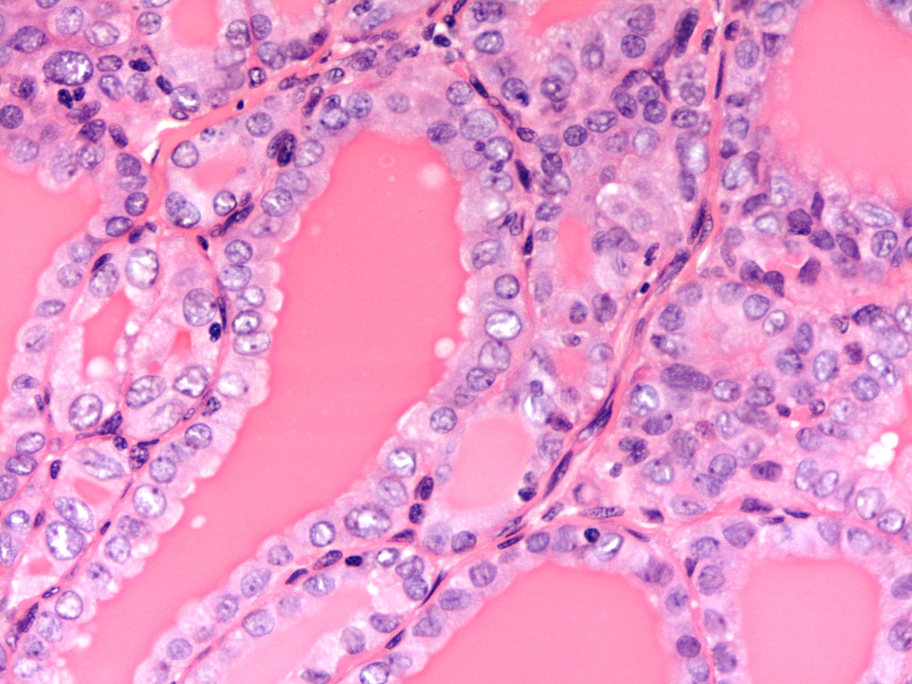 Papillary carcinoma
