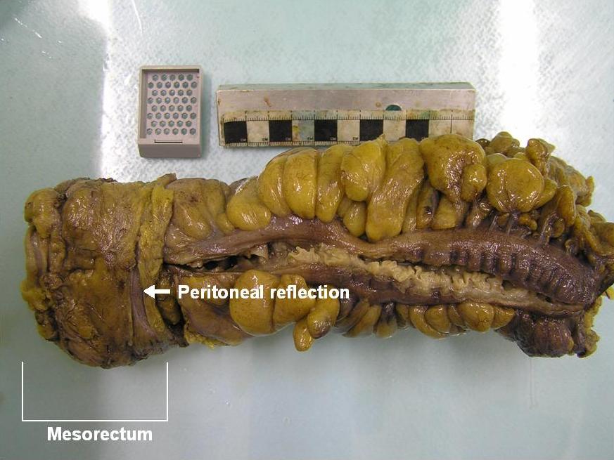 An anterior resection specimen