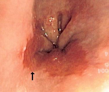 Barrett's oesophagus