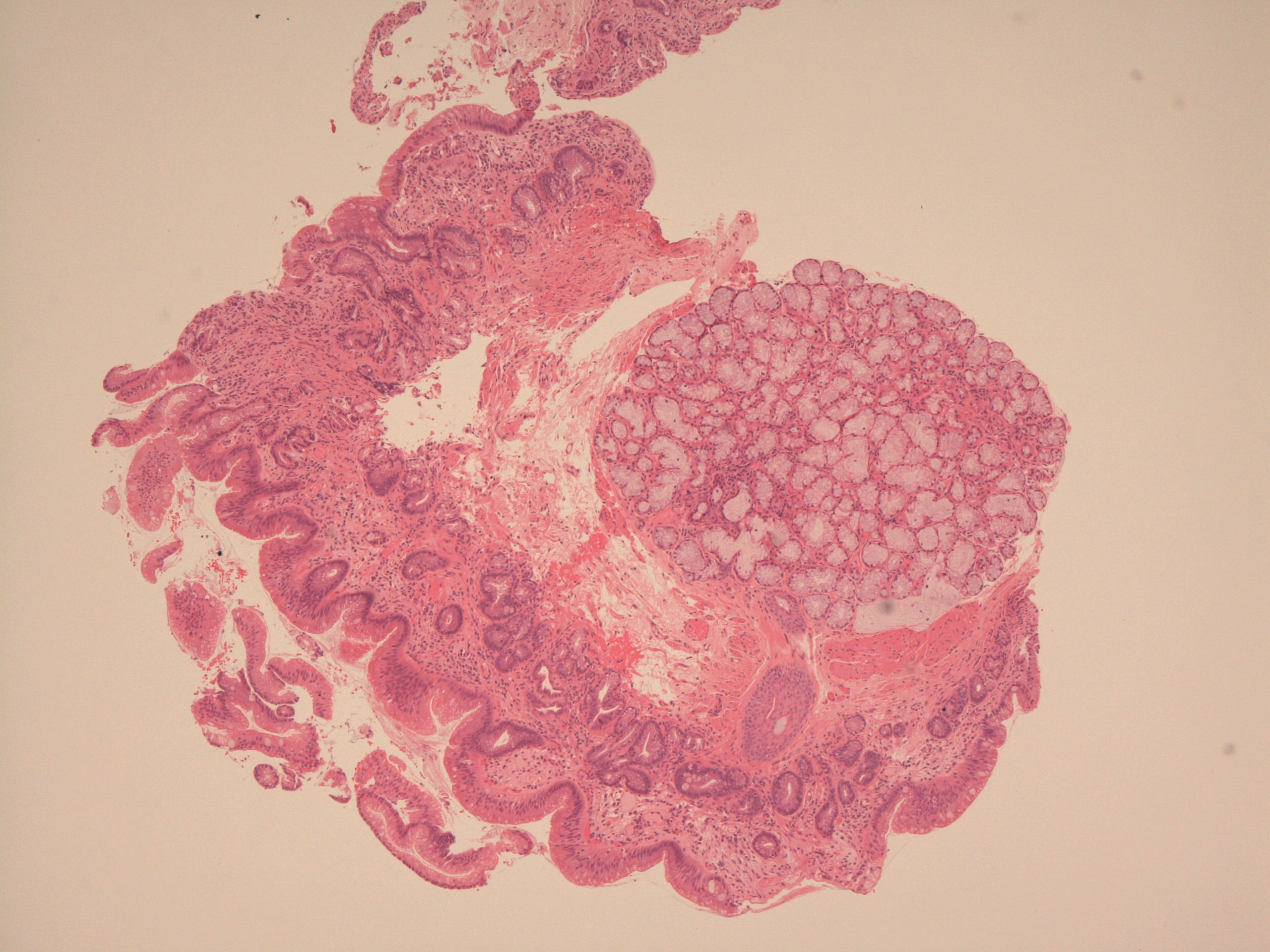 Barrett's oesophagus