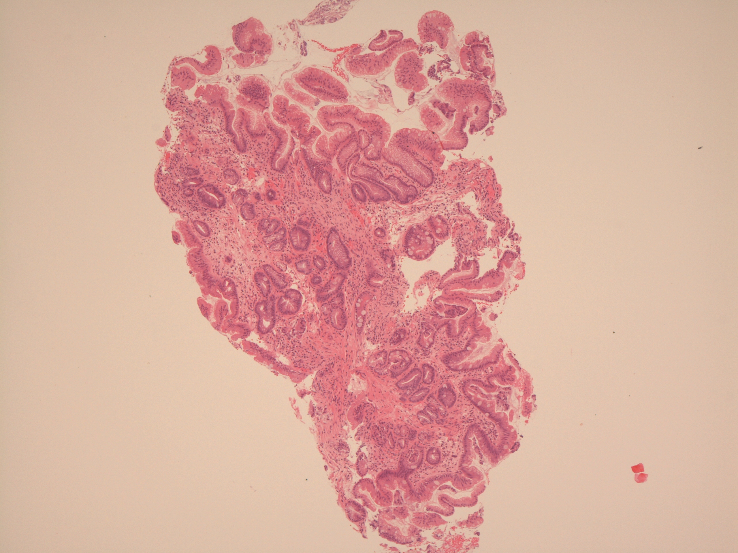 Microscopic image of Barrett's oesophagus