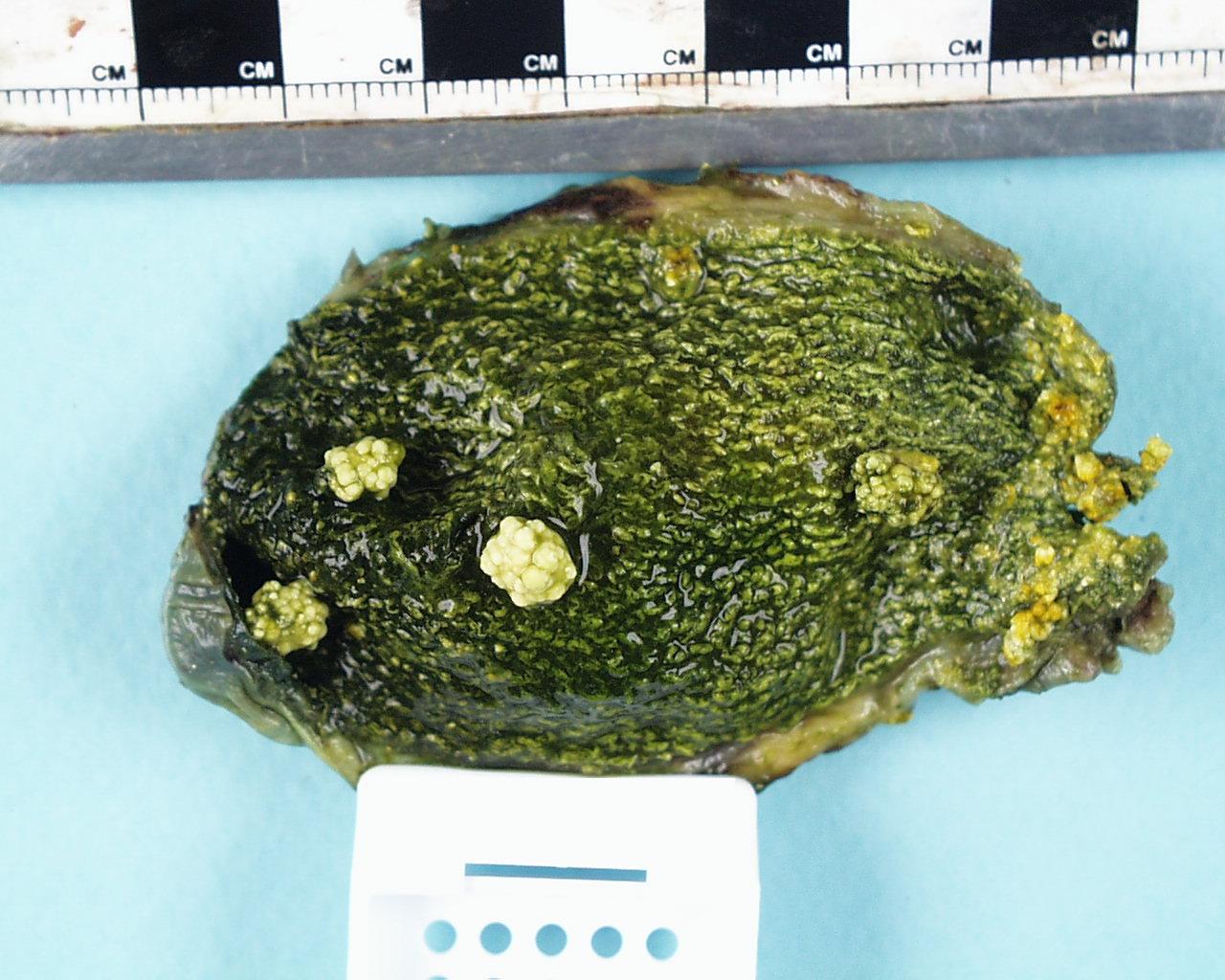 A macroscopic image of a gallbladder that shows cholesterolosis