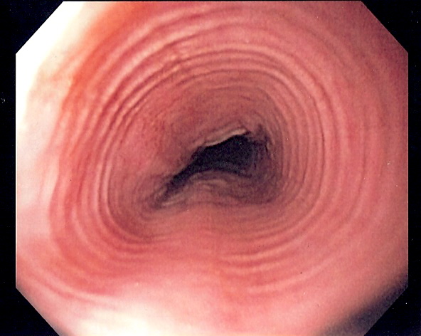Endoscopic view of eosinophilic oesophagitis