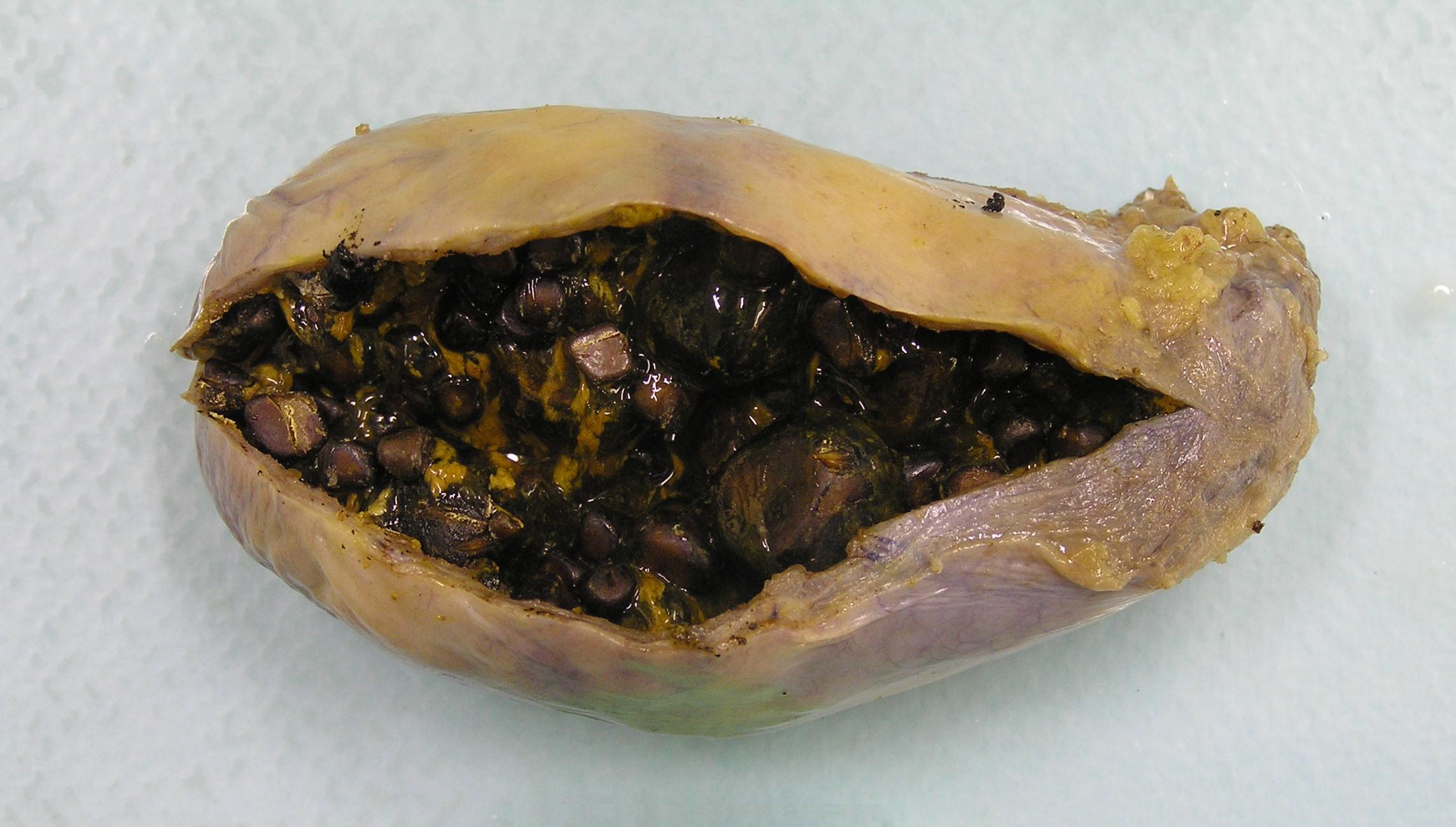 Image of a gallbladder which contains gallstones