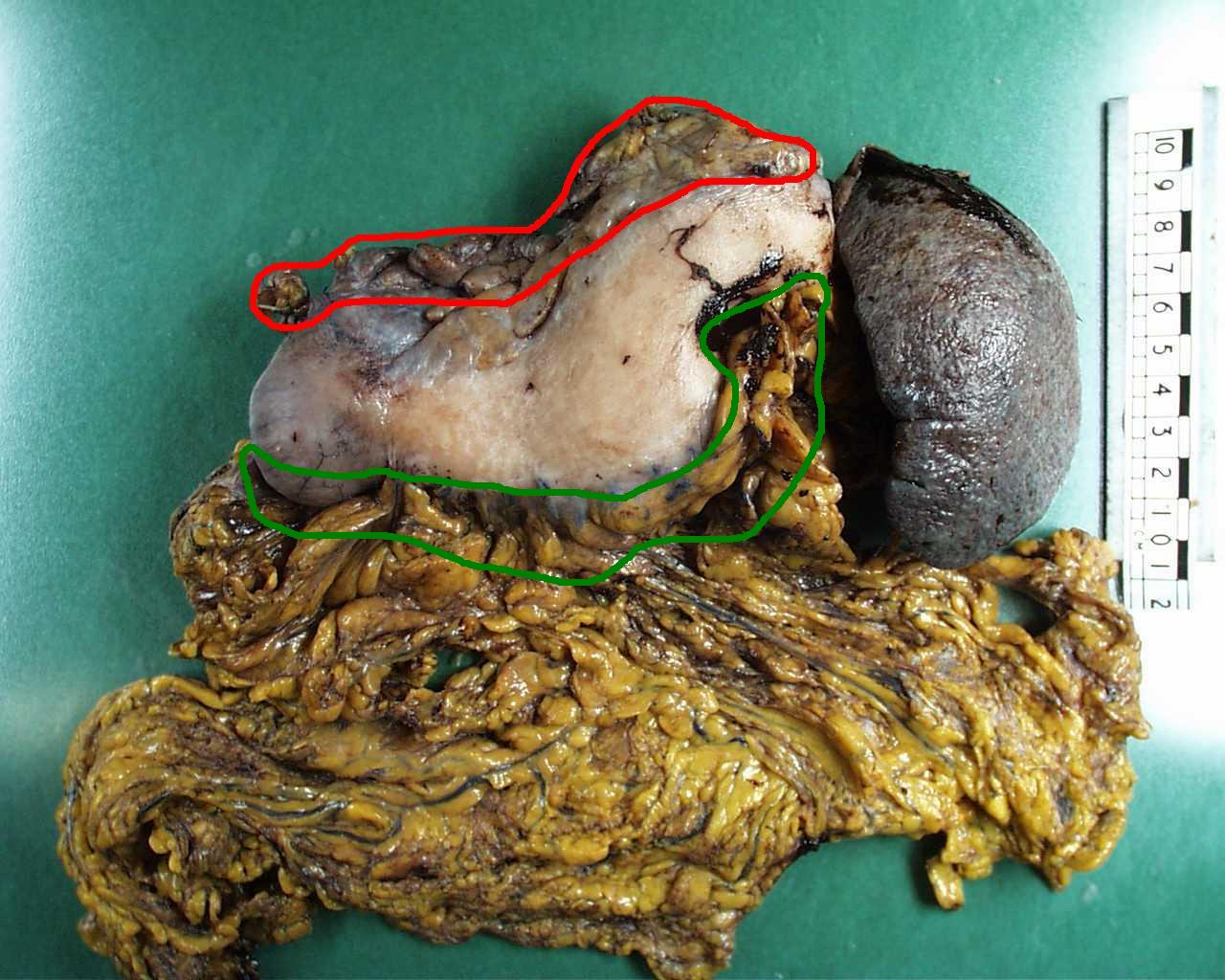 Gastrectomy