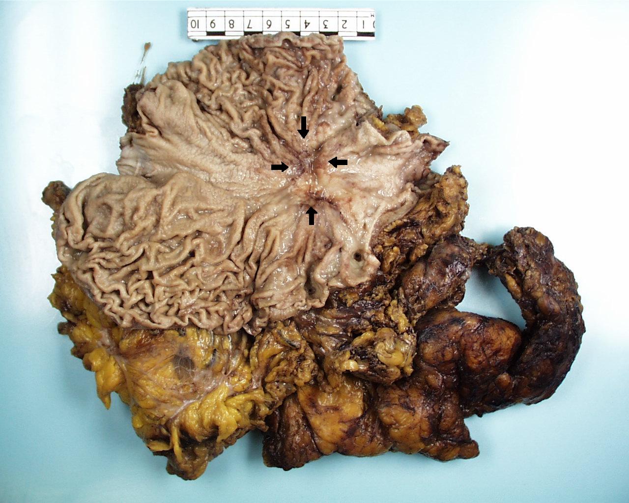 Gastric adenocarcinoma