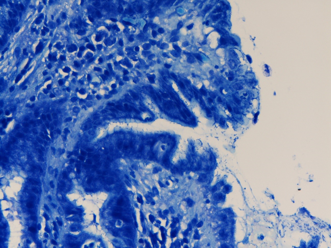 Helicobacter pylori