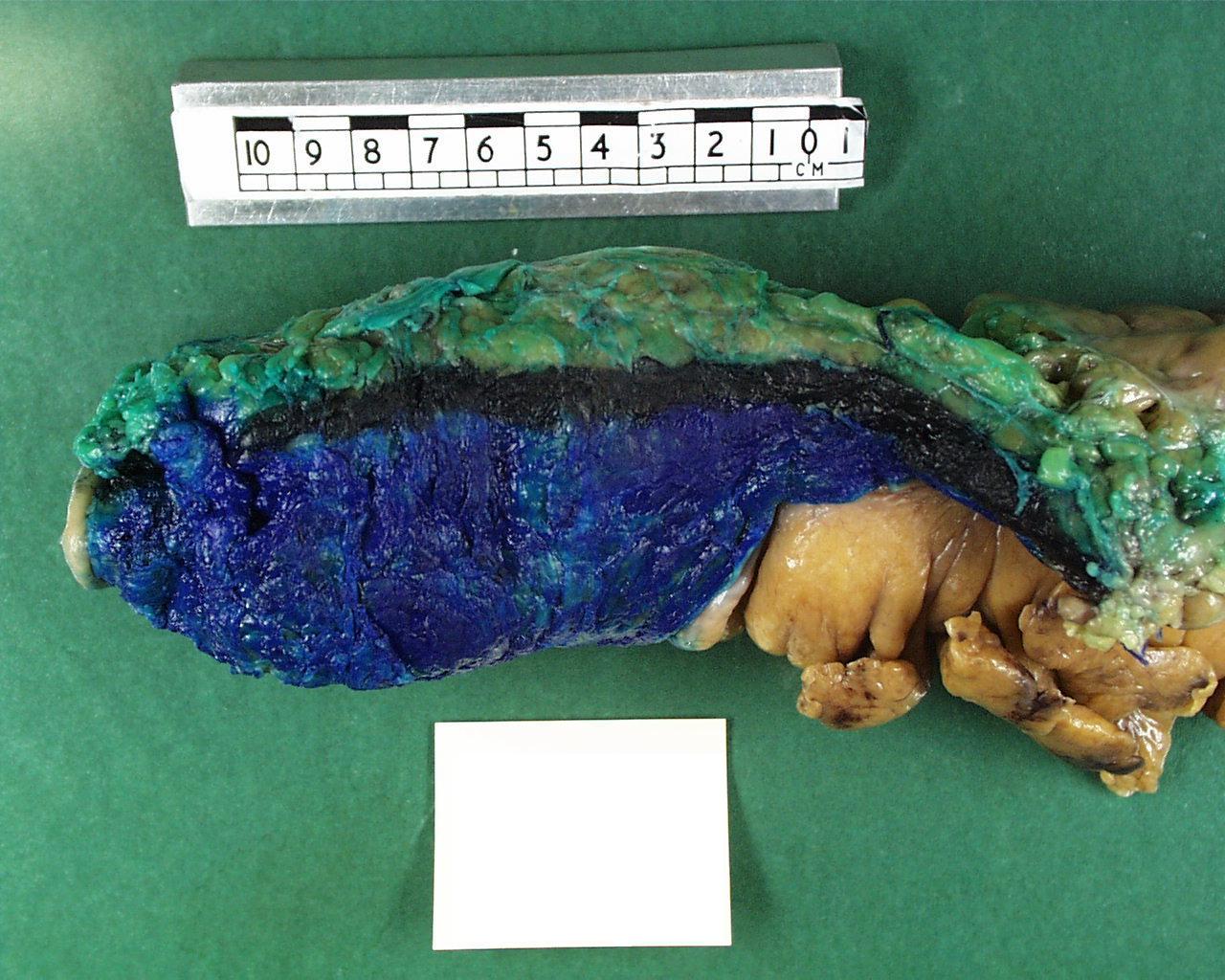 An anterior resection specimen with an inked mesorectal margin