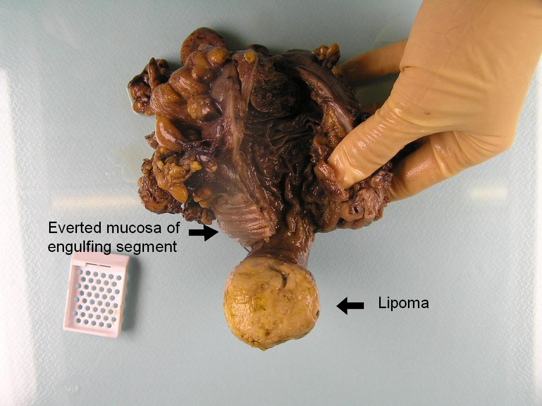Intussusception