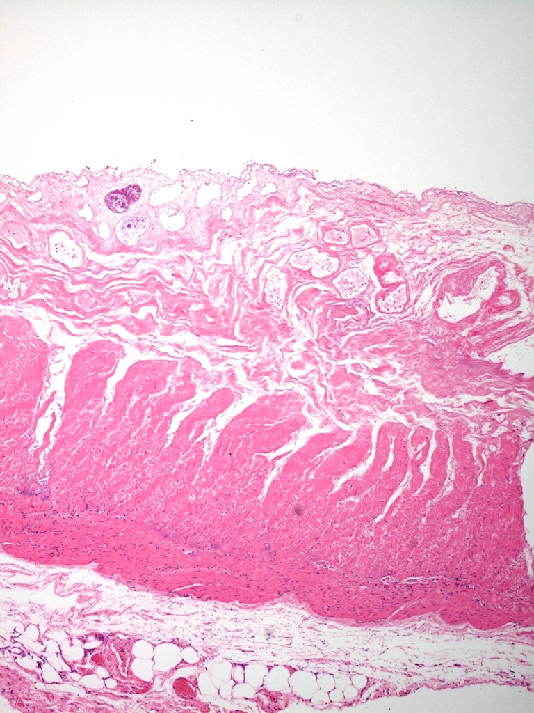 Microscopic image of intestinal ischaemia