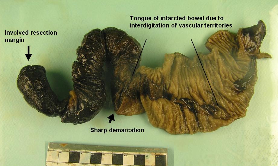 Ischaemic bowel