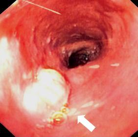 Oesophageal carcinoma