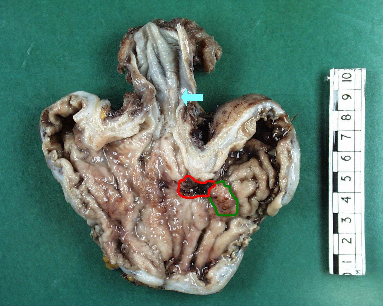 Oesophagogastrectomy