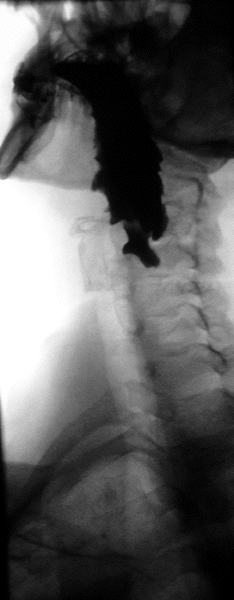 A pharyngeal pouch