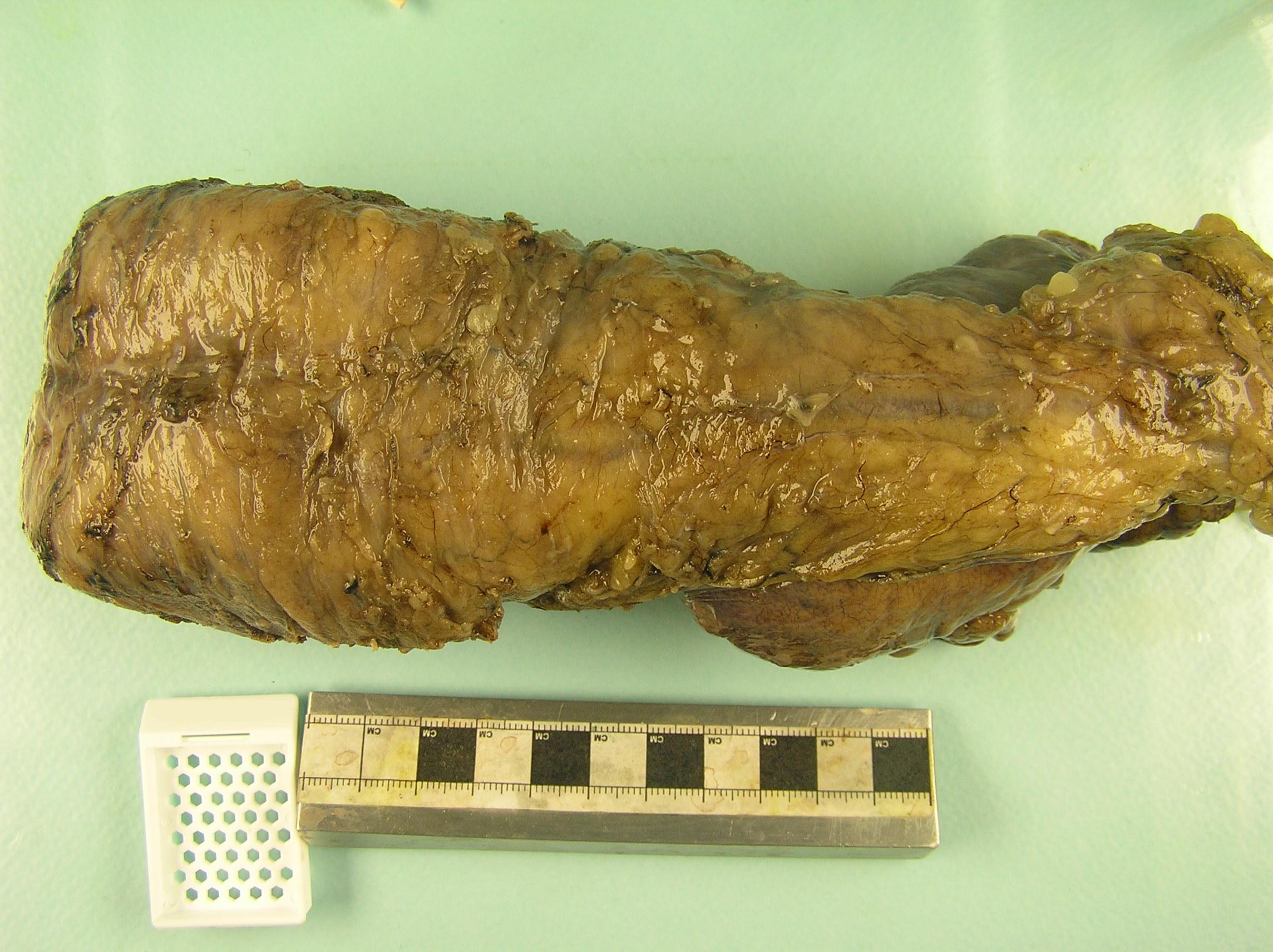 The posterior surface of an anterior resection specimen