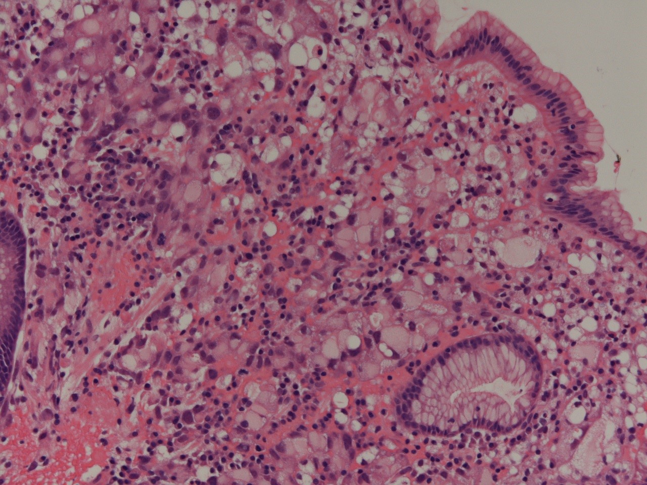 Signet ring cell adenocarcinoma
