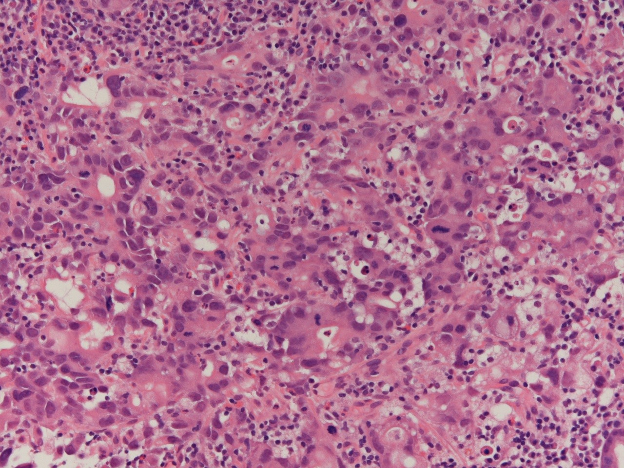 Signet ring cell adenocarcinoma