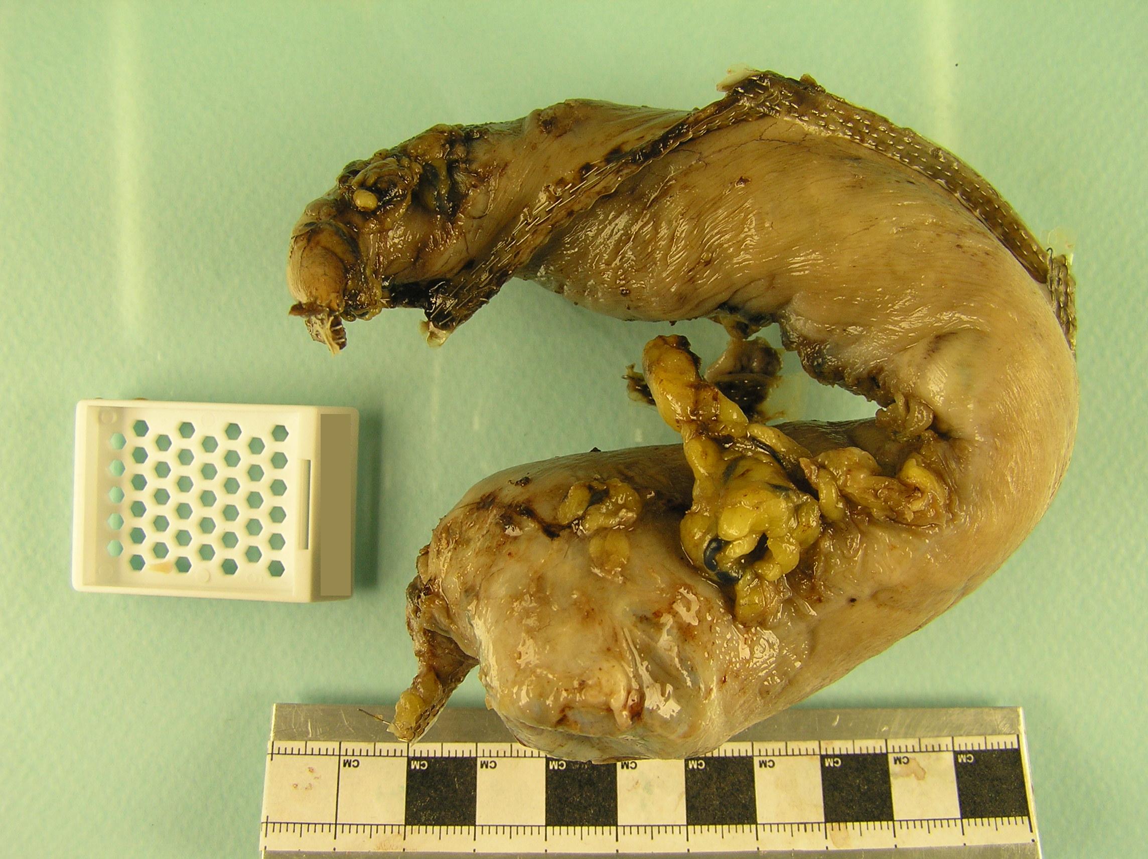 Sleeve gastrectomy