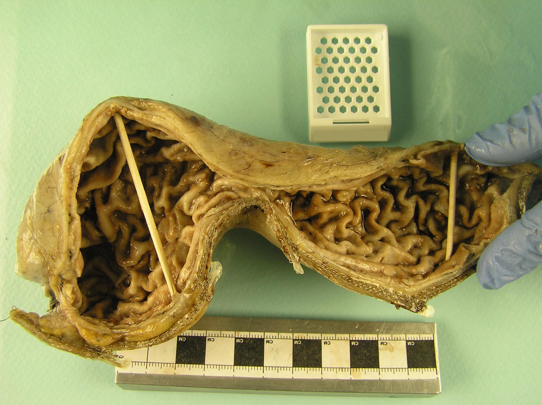 opened sleeve gastrectomy