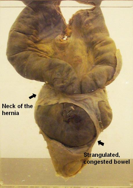 A strangulated hernia