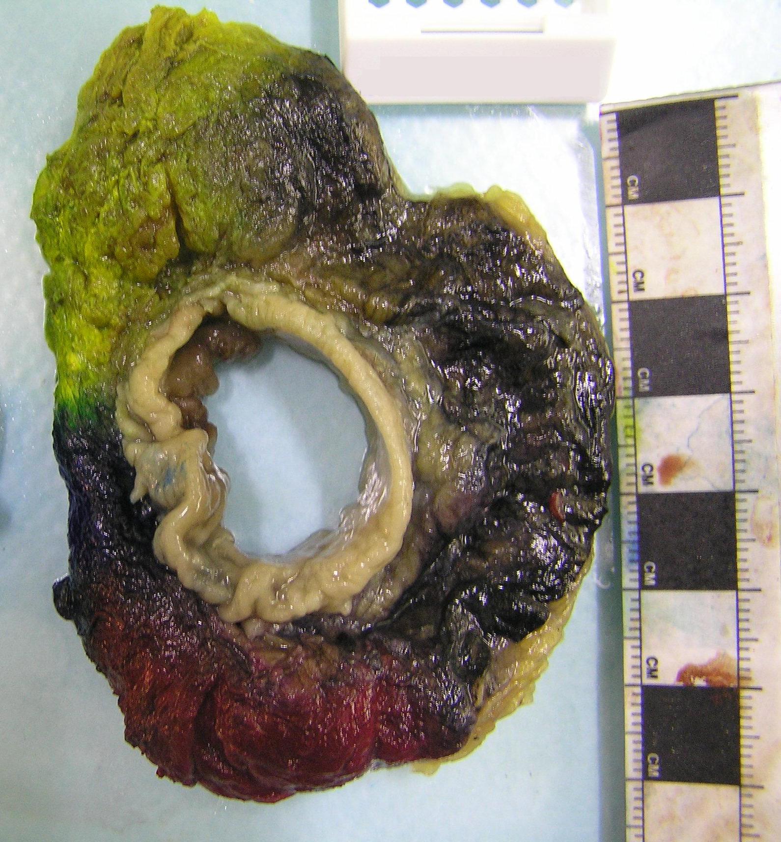 A transverse slice of an anterior resection with inked margin.