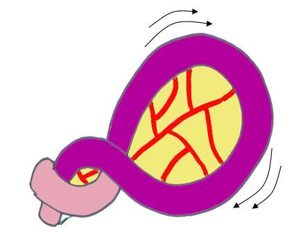 A diagram of volvulus