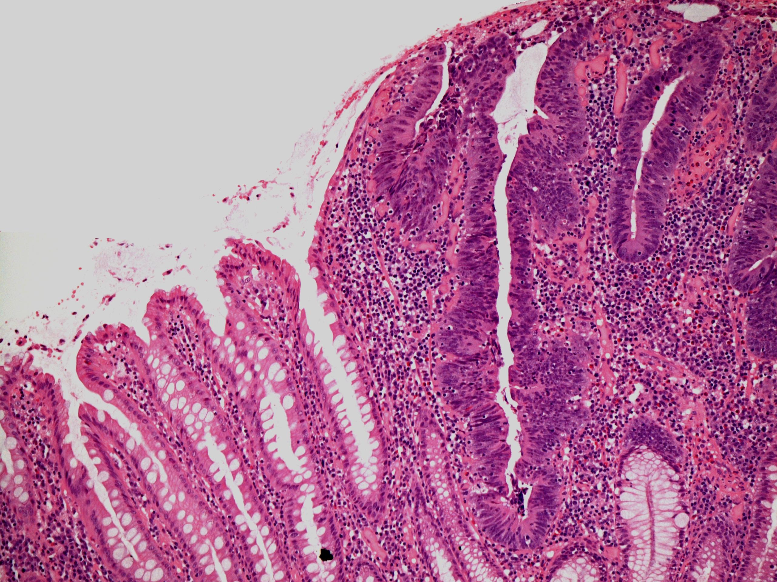 Dysplasia