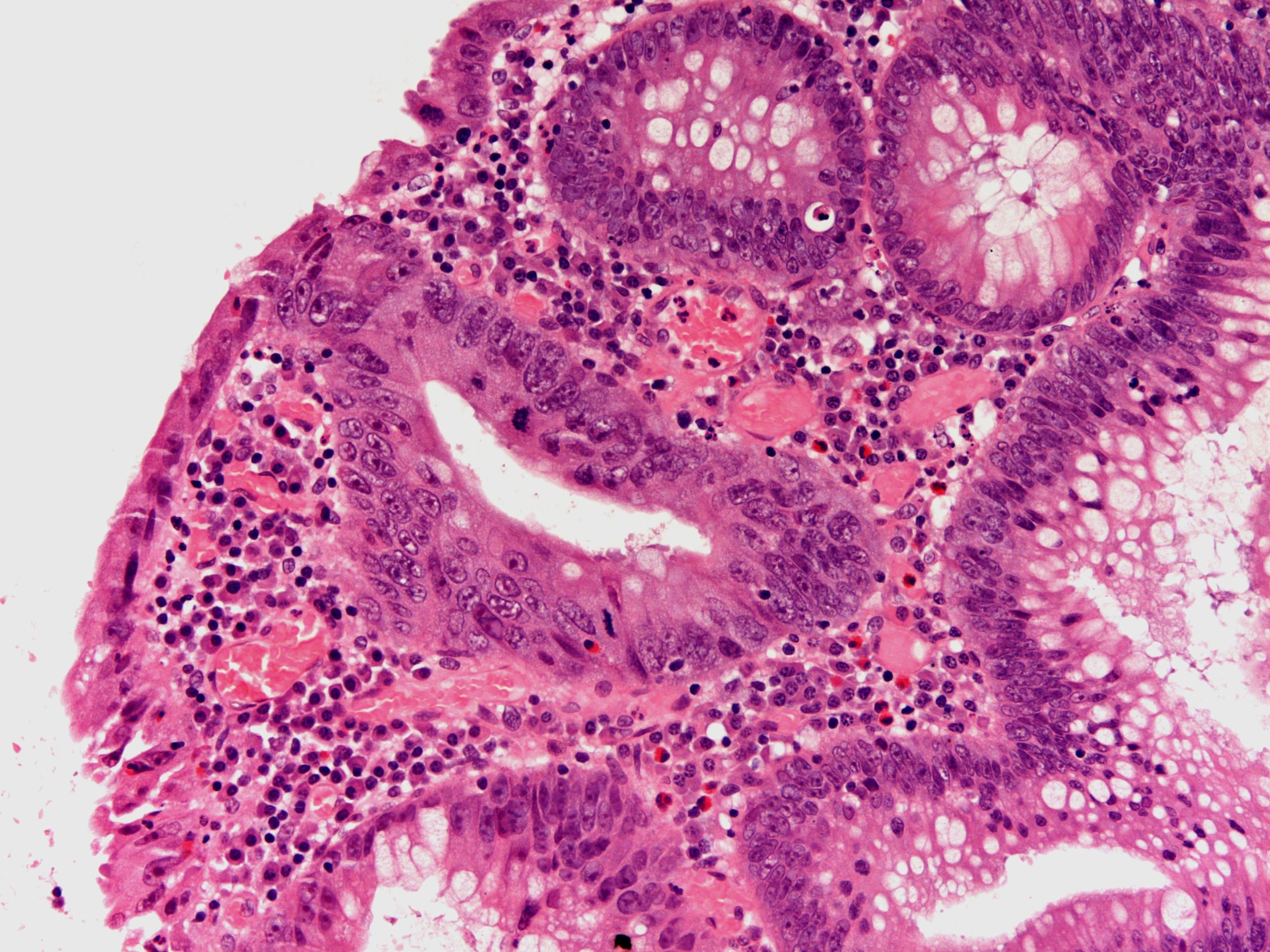 Dysplasia