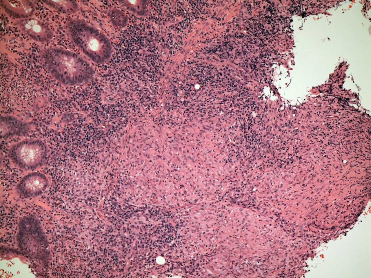 Granuloma