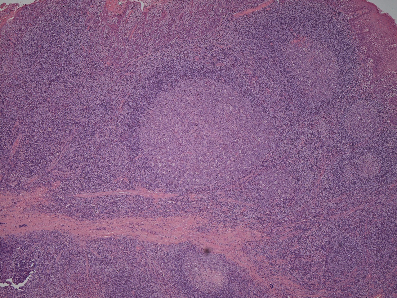Lymphoid Follicle