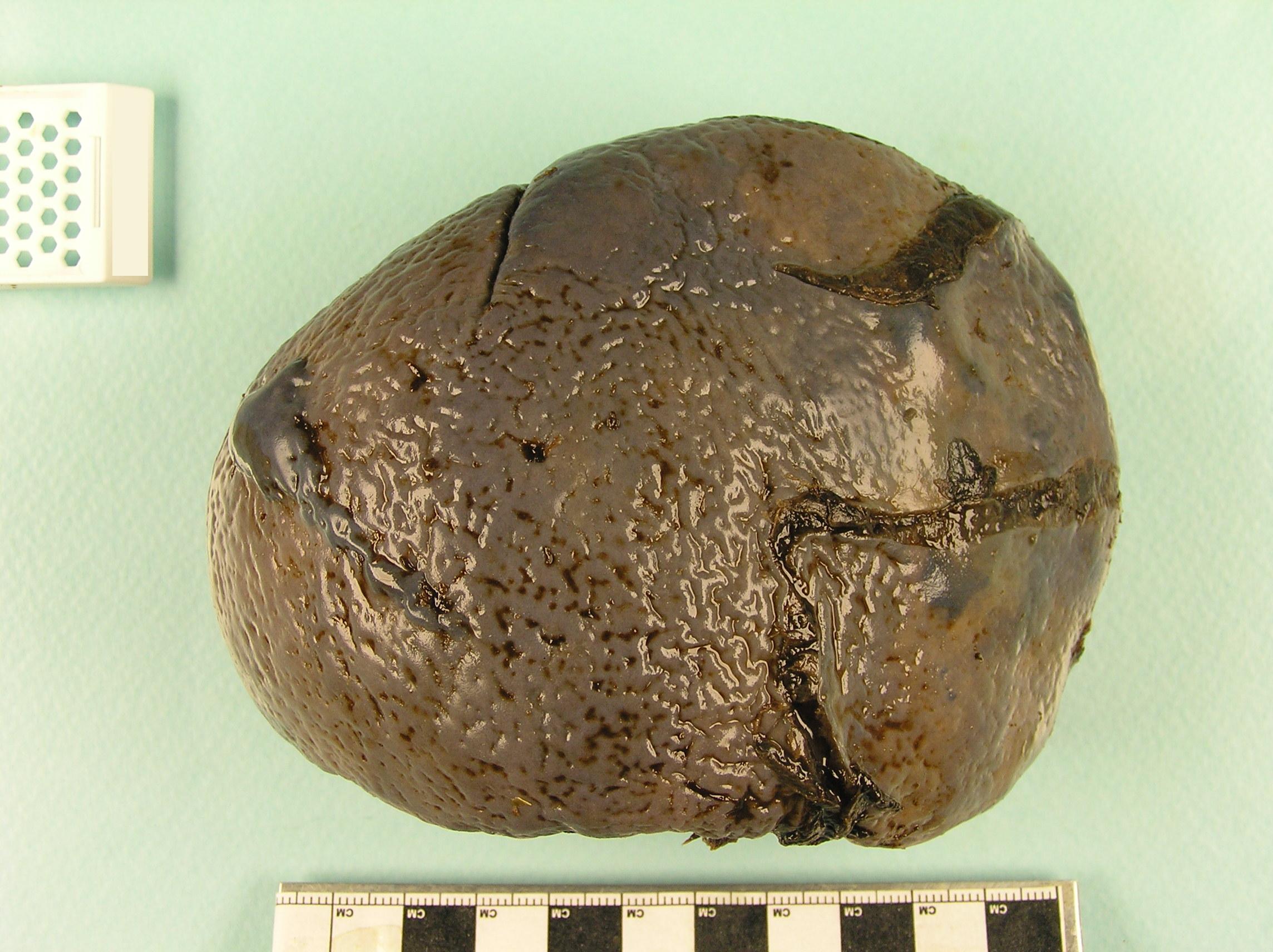 The Spleen