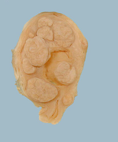 Uterus with fibroids